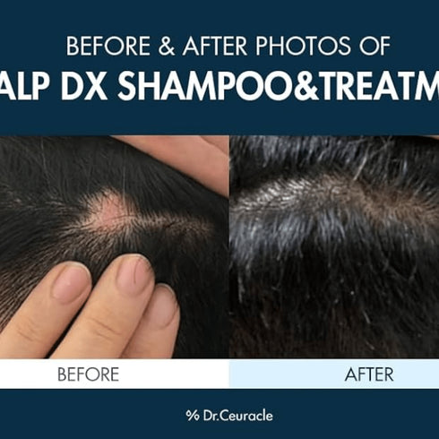 Scalp Dx Scalping Shampoo - WowSkin Romania